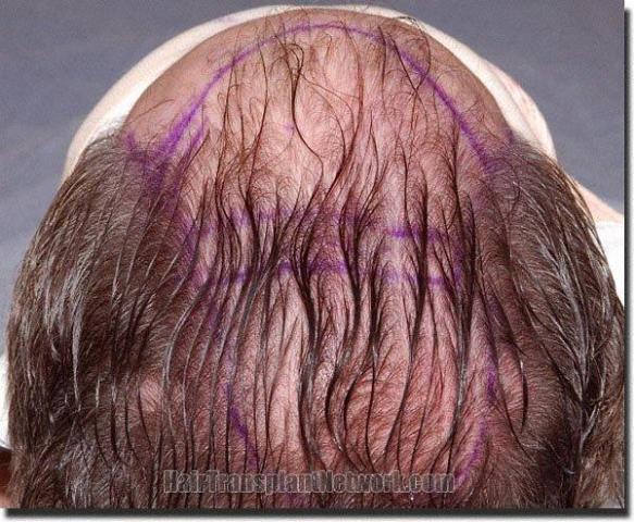 Hair restoration procedure results