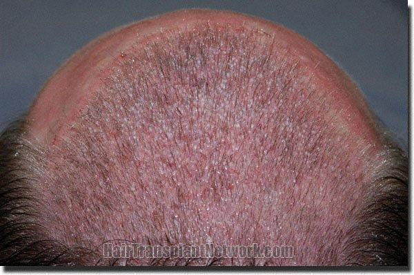 Hair restoration procedure results