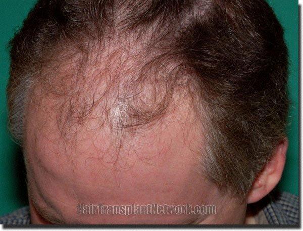 Hair restoration procedure results