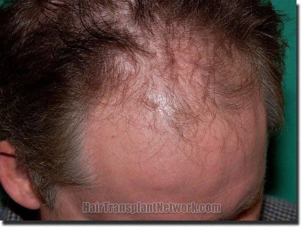 Hair restoration procedure results