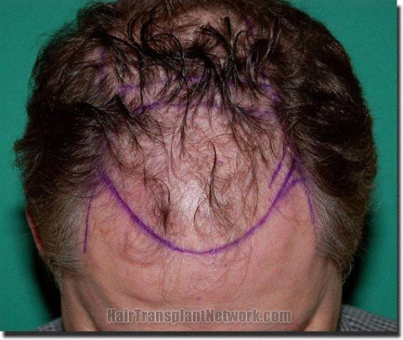 Hair restoration procedure results