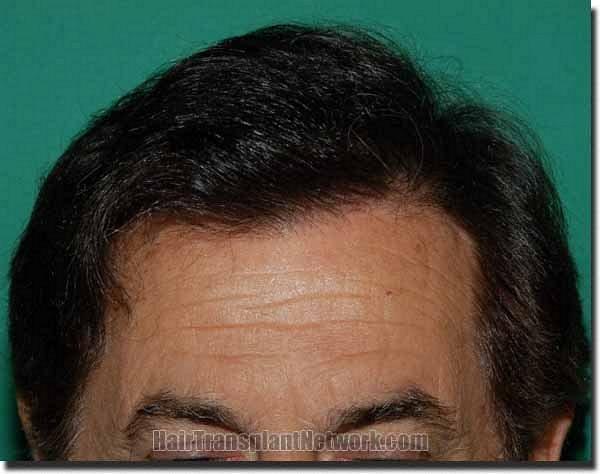 Hair restoration procedure results