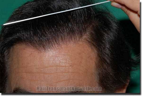 Hair restoration procedure results