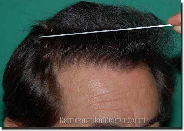 Hair restoration procedure results