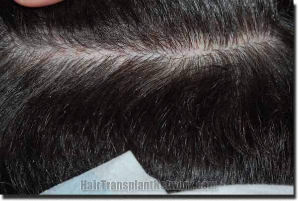 Hair restoration procedure results