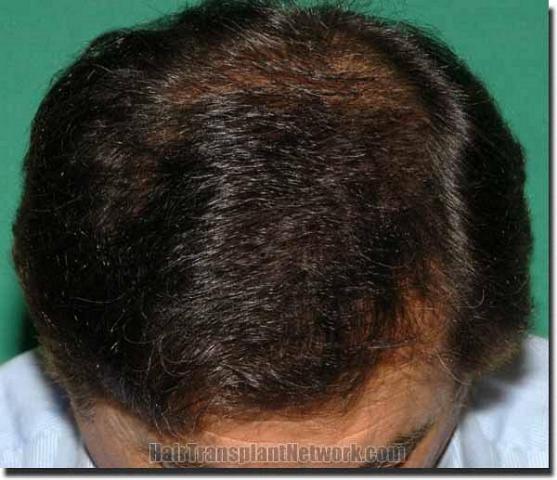 Hair restoration procedure results