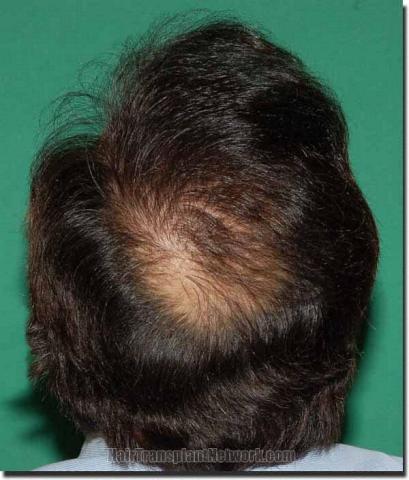 Hair restoration procedure results