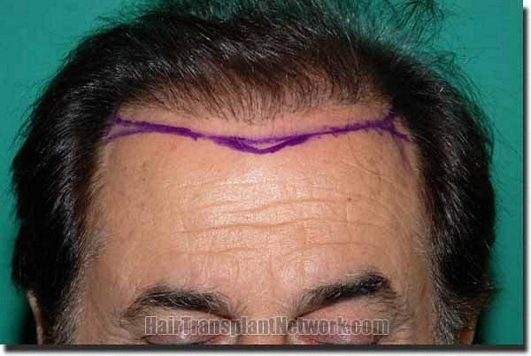 Hair restoration procedure results