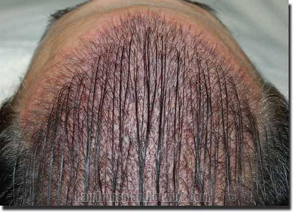 Hair restoration procedure results