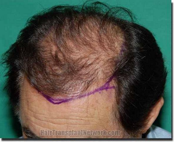 Hair restoration procedure results