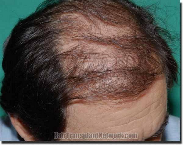 Hair restoration procedure results