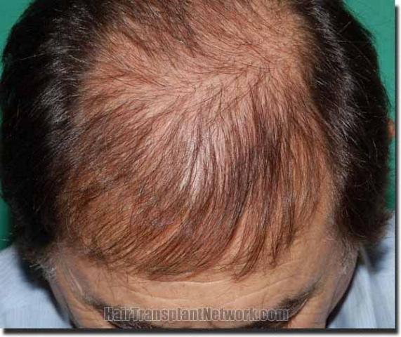 Hair restoration procedure results