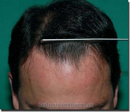 Hair restoration procedure results