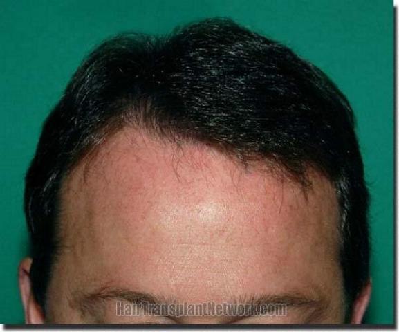 Hair restoration procedure results