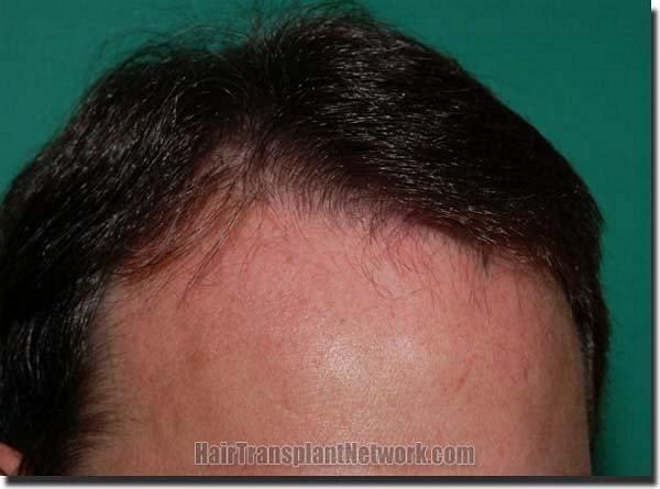 Hair restoration procedure results