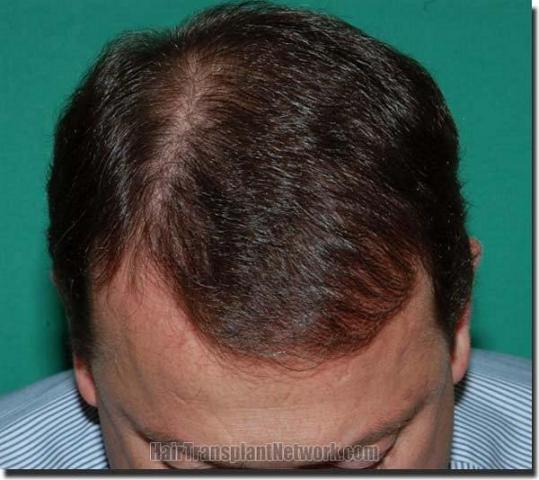 Hair restoration procedure results