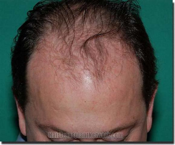 Hair restoration procedure results