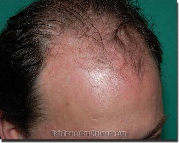 Hair restoration procedure results