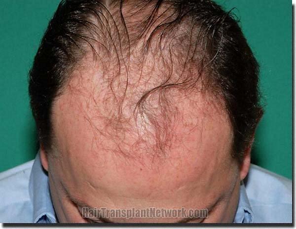 Hair restoration procedure results