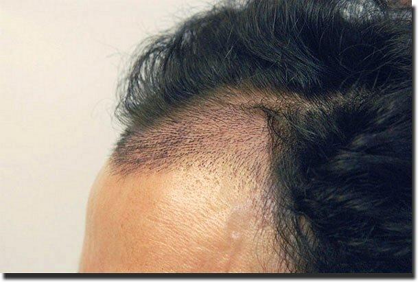 Hair restoration procedure results