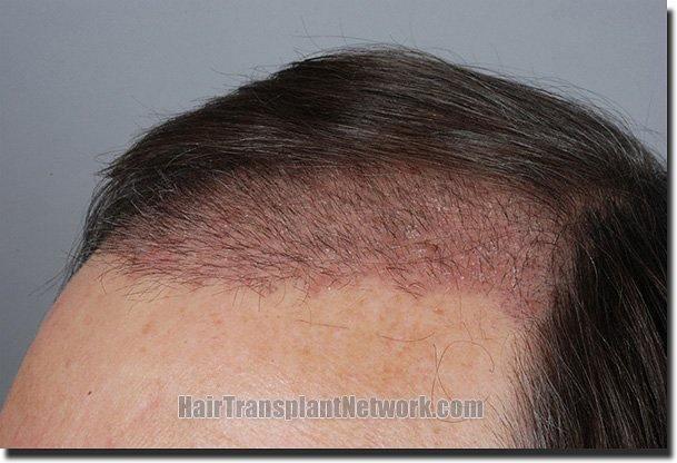 Hair restoration procedure results