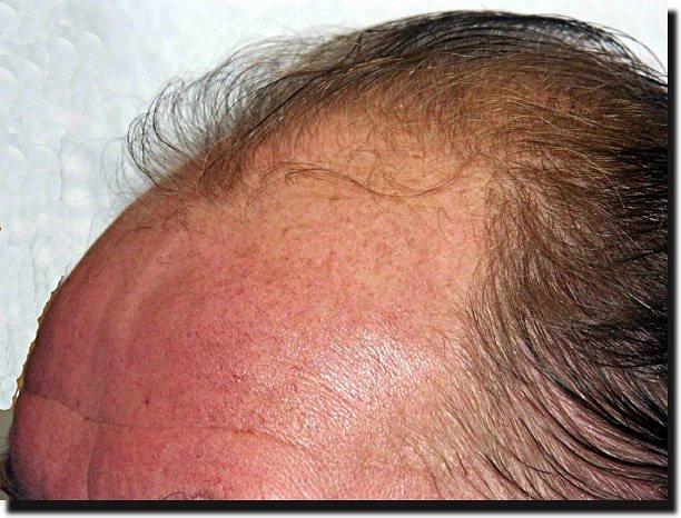 Hair restoration procedure results