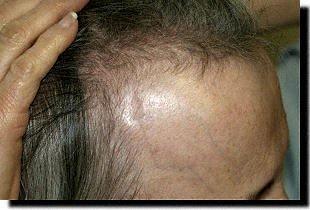 Hair restoration procedure results