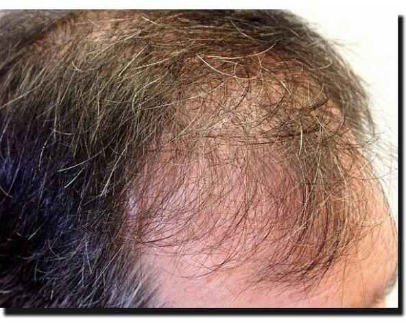 Hair restoration procedure results