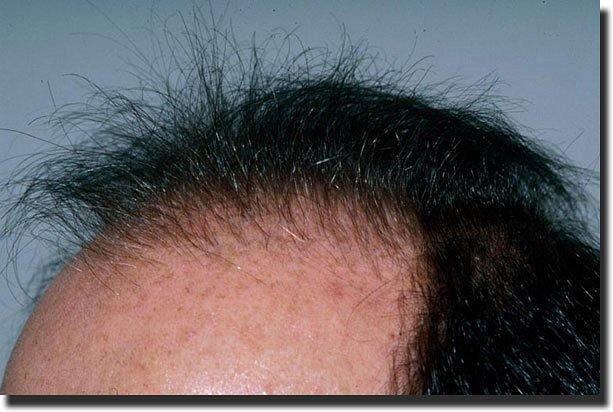 Hair restoration procedure results