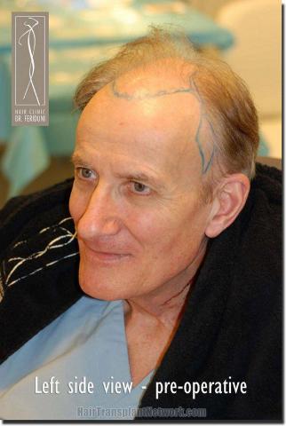 Hair restoration procedure results