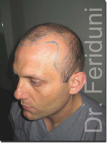 Hair restoration procedure results