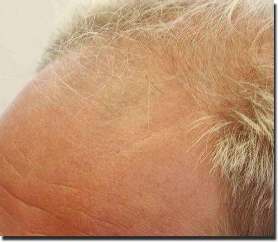 Hair restoration procedure results