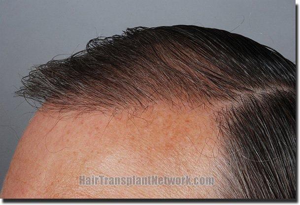 Hair restoration procedure results