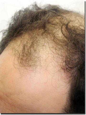 Hair restoration procedure results