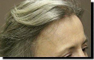 Hair restoration procedure results