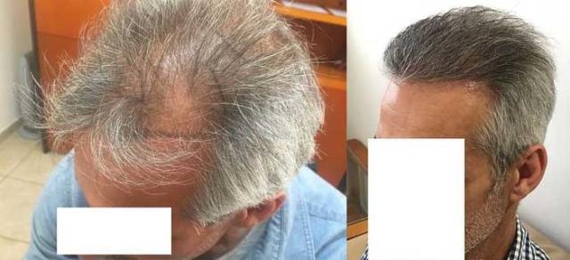Left view before and after 2800 FUE grafts