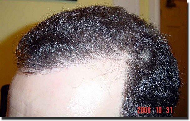 Hair restoration procedure results