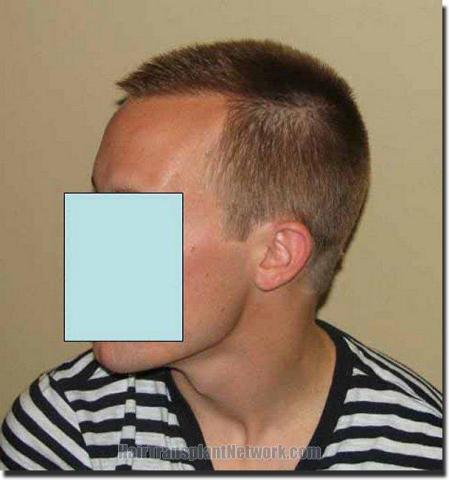 Hair restoration procedure results