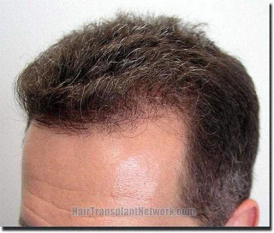 Hair restoration procedure results