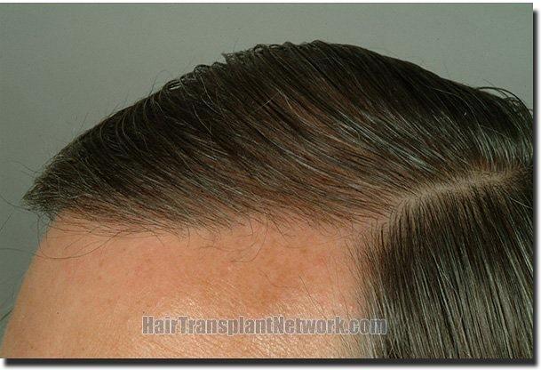 Hair restoration procedure results