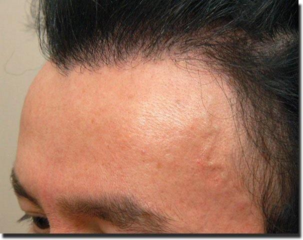 Hair restoration procedure results