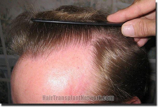 Hair restoration procedure results