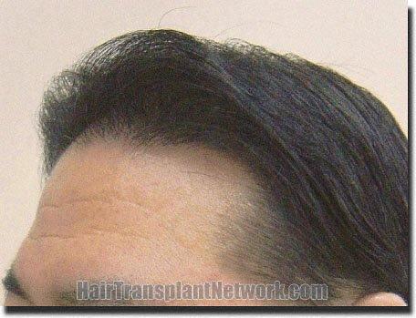 Hair restoration procedure results