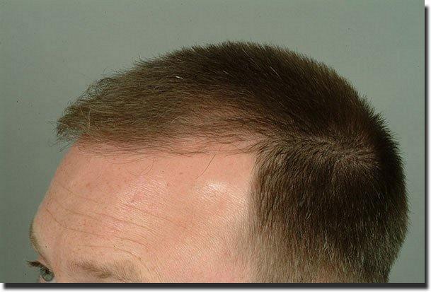 Hair restoration procedure results