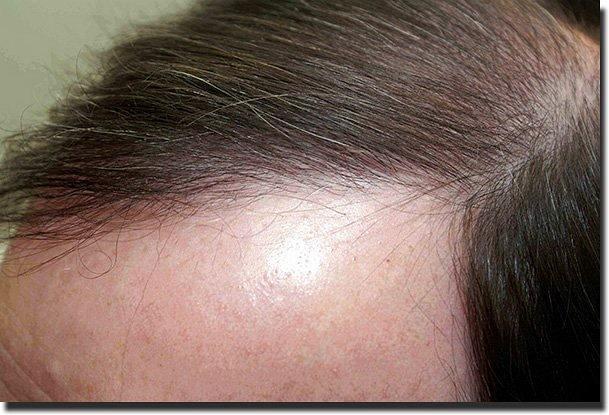 Hair restoration procedure results