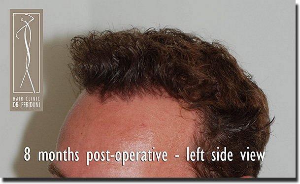 Hair restoration procedure results