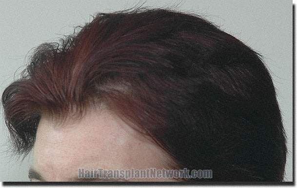 Hair restoration procedure results