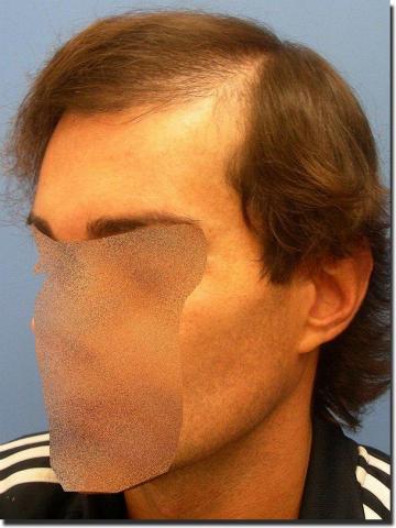 Hair restoration procedure results