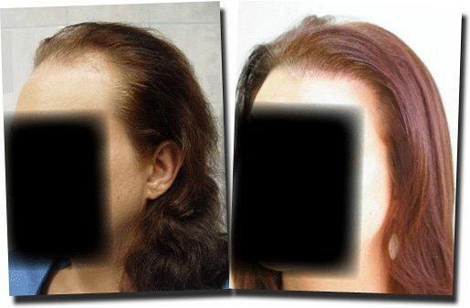 Hair restoration procedure results