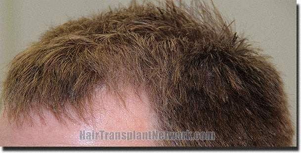 Hair restoration procedure results